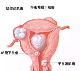 子宮肌瘤千萬不能割，誰割誰后悔